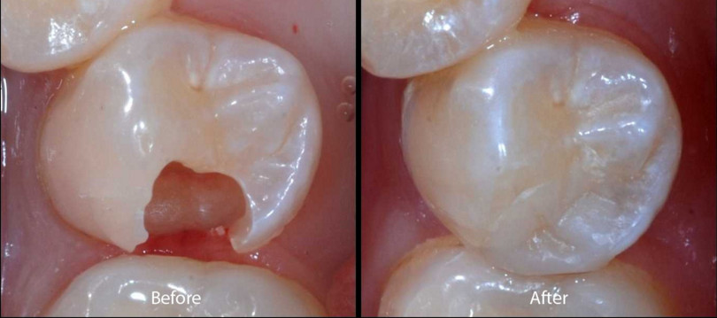 Trám răng thẩm mỹ là như thế nào?