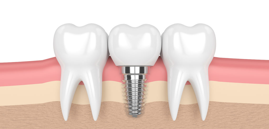 Implant cho ông bà: Người cao tuổi cấy Implant?