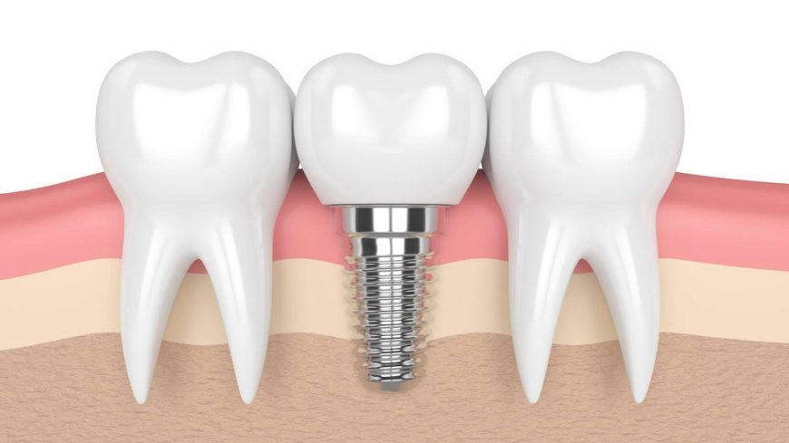 Phương pháp Implant