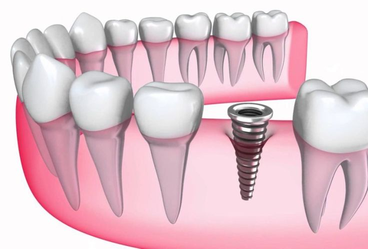 Phương pháp Implant Chất lượng