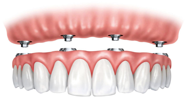 Phương pháp Implant Uy Tín