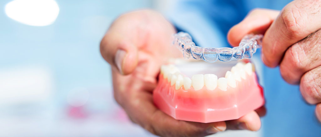 Invisalign thiết kế riêng: Toàn tập về Invisalign