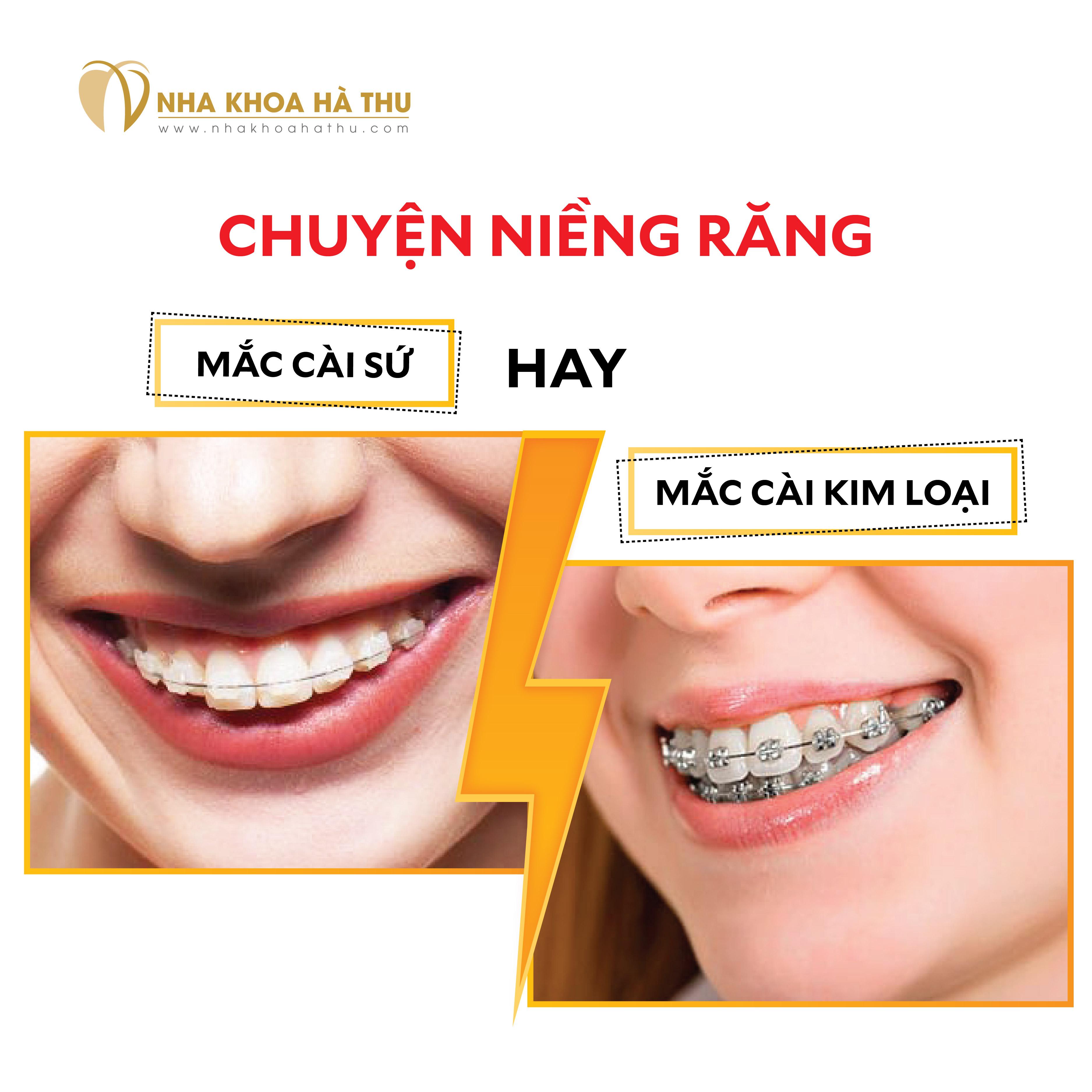 Chuyện niềng răng: Mắc cài sứ hay Mắc cài kim loại